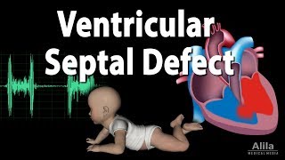 Ventricular Septal Defect Animation [upl. by Hourihan]