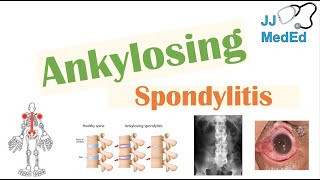 Spondylosis and Social Security Disability [upl. by Einiffit308]