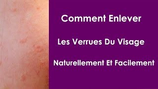 Comment Enlever Les Verrues Du Visage Naturellement Et Facilement [upl. by Josephine799]