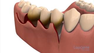 Periodontal flap approach surgery  Lapointe dental centres [upl. by Iong]