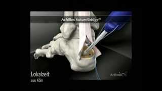 AchillessehnenEntzündung Neue Operationsmethode ORTHOPARC Klinik [upl. by Sinnard]